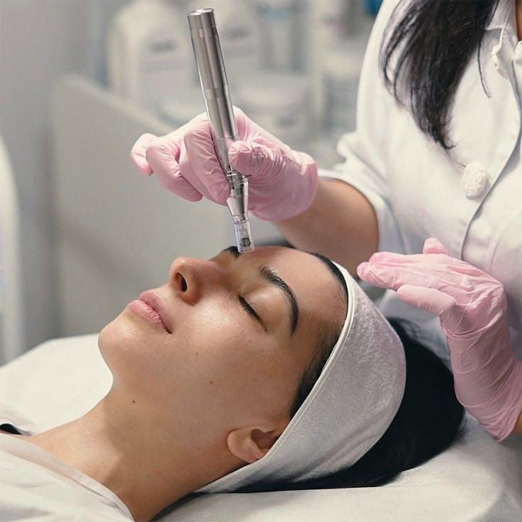 Microneedling Treatment